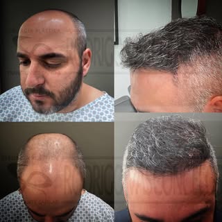 Chega de se aventurar por aí…

#Transplante capilar não é corte de cabelo! 
Qdo o corte de cabelo nã