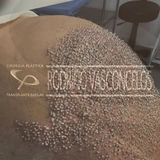 Transplante Capilar só se tiver esse selo!!!

Dr Rodrigo Vasconcelos é cirurgião plástico e atua com