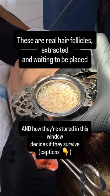 This is the stage of a hair transplant nobody films — and it’s one of the most important.
Once folli