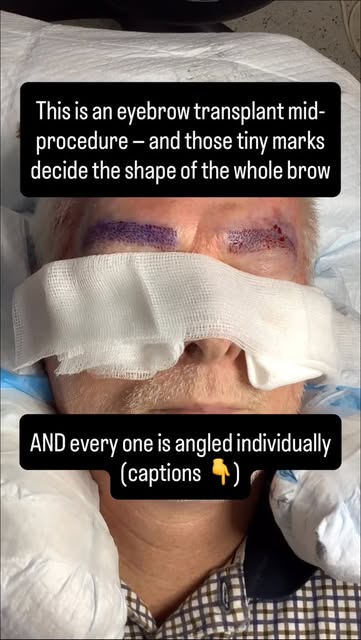 This is the stage of an eyebrow transplant that decides everything — before a single hair goes in.

