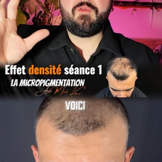Séance 1 d'effet densité #micropigmentation

La première séance de micropigmentation capillaire effe