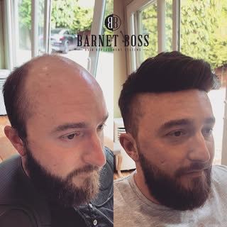 Amazing transformation for Jack. This guy thought he might be too bald to have a system but with the