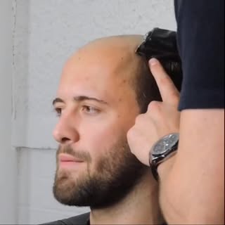From no hair to hair 🙌🏼🙌🏼 check out this transformation 🤩🤩🤩