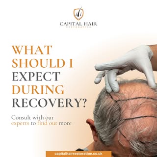 Wondering what recovery after a hair transplant looks like? The healing process is just as important