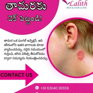 Ringworm? Get It Checked!

Itchy, circular or reddish patches on your skin? Don’t ignore them.

Ring
