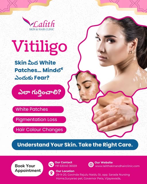 Vitiligo ante skin meeda white patches kanipinchadam maatrame kaadu — correct diagnosis and timely d