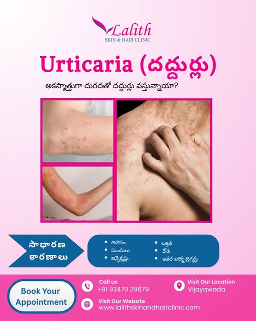 Urticaria, commonly known as hives, can cause sudden itchy, raised rashes on the skin. Triggers can 