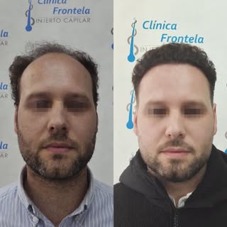 No es solo pelo. Es cómo te vuelves a mirar al espejo.

CLÍNICA CAPILAR FRONTELA
Zaragoza | Sevilla 
