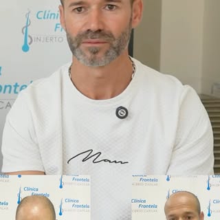 Hoy Miguel comparte el resultado de ese camino: un cambio natural, diseñado para respetar su imagen 