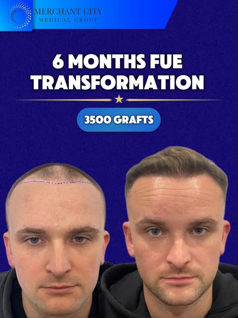 ⭐️ Amazing transformation in just 6 MONTHS. This hair restoration journey highlights what a tailored