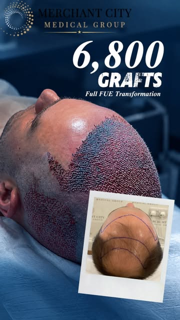 6,800 grafts. One BIG FUE case.🙌
A close look at the beginning of this incredible transformation in