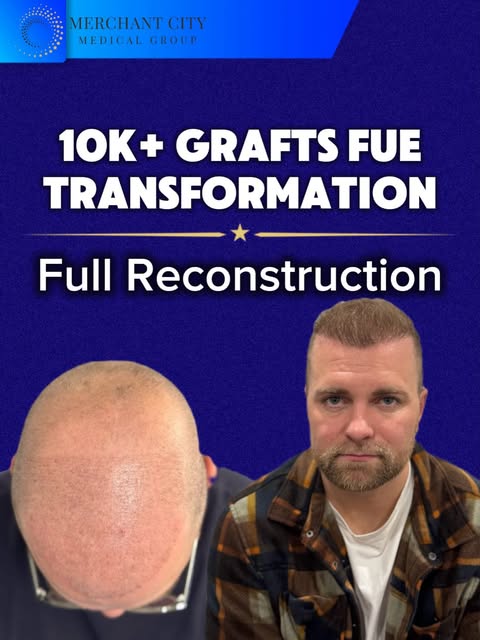 From bald to bold.😀✅ A truly transformative case. One year. 10k+ Grafts.
A carefully planned approa