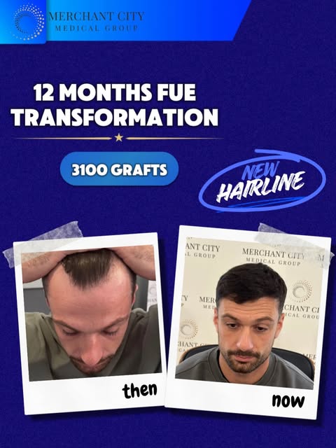 12 Months. 3000+ Grafts. One completely redefined hairline. 
One year later, the results speak for t