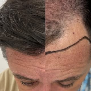 Hoje, transplante capilar não é mais um produto de prateleira.
Não é algo padronizado, que sai igual
