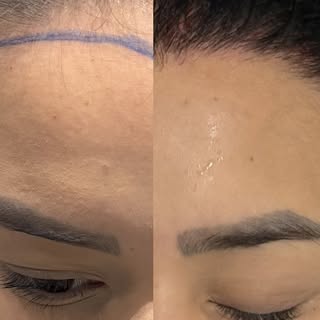 Transplante capilar FUE feminino, redução de linha frontal. Extrema naturalidade e perfeccionismo!
R