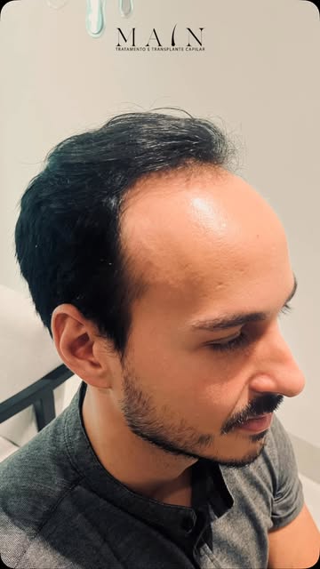 Será que é peruca? É a mesma pessoa? 🤔 
Transplante capilar faz diferença?
Olhe o antes e depois e 