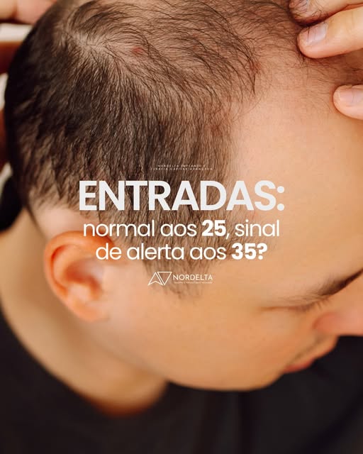Entradas no cabelo é sempre sinal de calvície? Nem sempre. 👀
Leia o post pra entender!

Ficou na dú