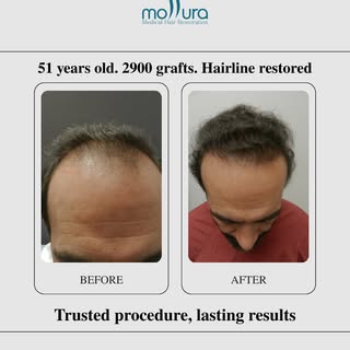 1 Session
Customized Plan
Natural Results

Longs Island's Most Experienced Hair Restoration Clinic.