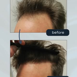Restore Your Hair Line Today with Mollura Medical