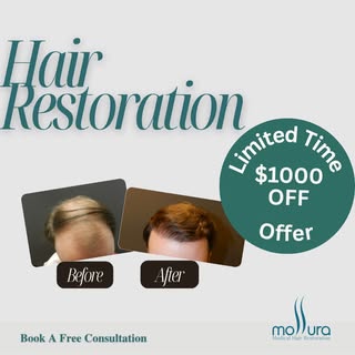 Summer Hair Restoration Promo

Book your consultation today and receive $1,000 off your hair transpl