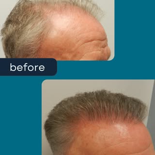 1 Session
Customized Plan
Natural Results

When considering hair restoration, don't go with a cookie