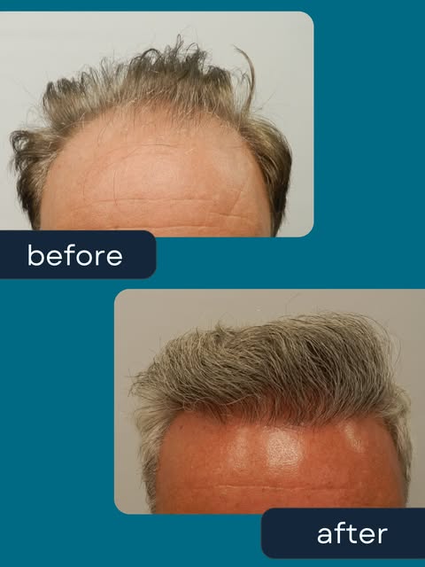 8 months after his FUE hair transplant, this patient came back with a brand new head of hair and a b