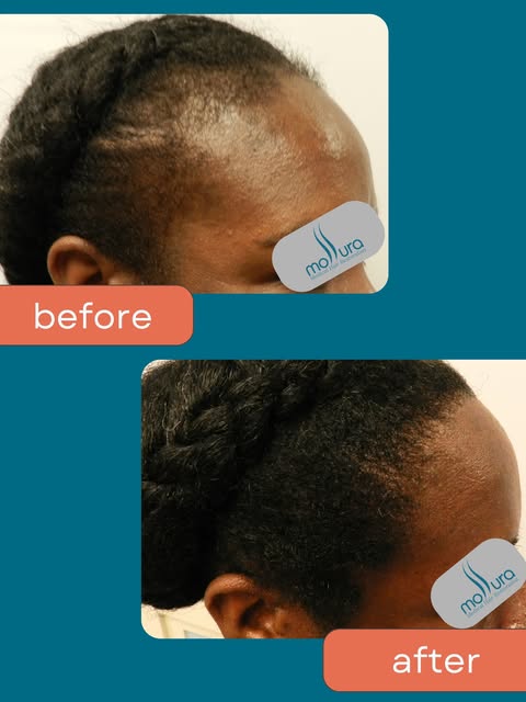 Traction alopecia doesn't have to be permanent. Swipe to see the the transformation over 8 months.