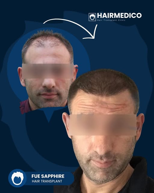 3300 grafts. One carefully planned transformation. ✨

A natural hair transplant is not simply about 