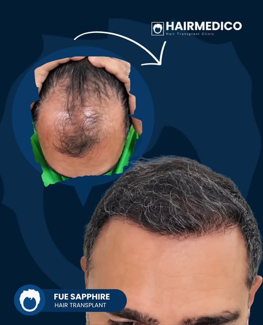 The goal was never “more hair.” The goal was the right hair, in the right place, at the right angle.