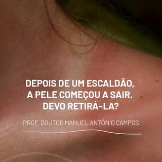 Depois de um escaldão, a pele começou a sair. 
Devo retirá-la?

Prof. Doutor Manuel António Campos –