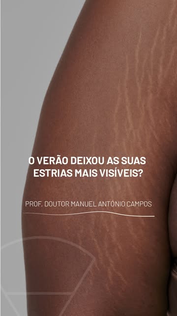 O VERÃO DEIXOU AS SUAS ESTRIAS MAIS VISÍVEIS?

O verão terminou, mas pode ter reparado que as estria