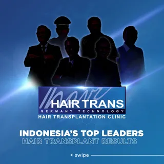 Presenting: TOP LEADERS INDONESIA yang telah melakukan hair transplantation di Surabaya HairTrans Cl