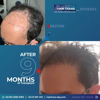 9 MONTHS TO GROW FULLY!! Rambut pasien rata-rata membutuhkan waktu antara 7-11 bulan agar hasil tran