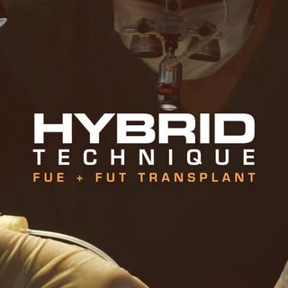 Introducing: Hybrid Hair Transplant. A combination of FUE and FUT method that will maximize your hai