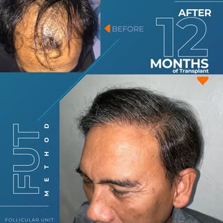 Nothing can stop you from baldness from now on..! Make it happen with us!

Consult your hairfall pro