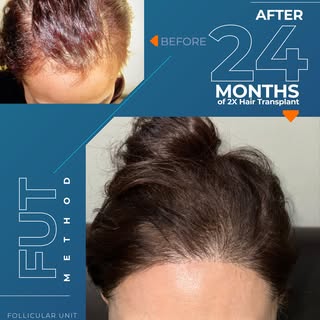 Kemunduran / penipisan rambut pada kepala dapat terjadi pada siapa saja, termasuk wanita. Penyebabny