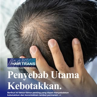 Pernahkah anda mulai mengamati kenapa rambut anda lebih sering rontok akhir-akhir ini? Atau tiba-tib