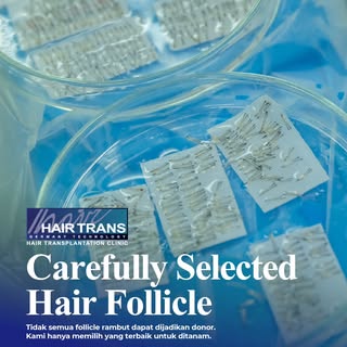 In Surabaya Hairtrans Clinic, we always count by the successful harvested hair follicles, not by the