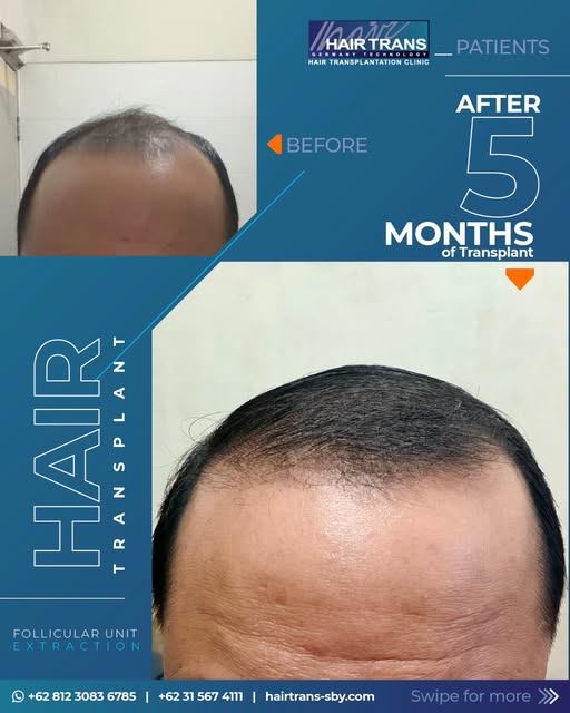 Wonder what's the result of FUE transplant with Neograph technology? Here it is!! 5 months, and you'