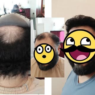 linking technique ideal for those of u with hair on the perimeter but just balding on top (blog comi