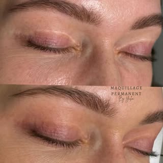 Découvrez les résultats incroyables du camouflage des cicatrices après une blépharoplastie 😍

Ma te