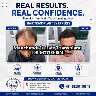 Another successful hair transformation!
Natural hairline. Permanent results. Confidence restored
.
�