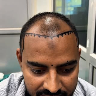 Take the next step towards restoring your hairline and achieving a fuller, natural-looking appearanc