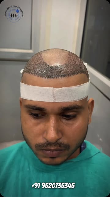 ✨ A Natural Hairline. A Confident You.

Hair transplant treatment can help restore the appearance of