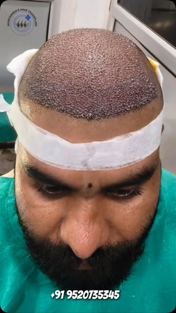 Hair transplant treatment can help restore the appearance of a fuller hairline and improved hair cov