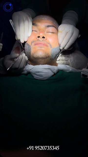 ✨ Natural Beard. Naya Confidence.

Beard transplant successfully done!
Ab patchy beard ki jagah a fu