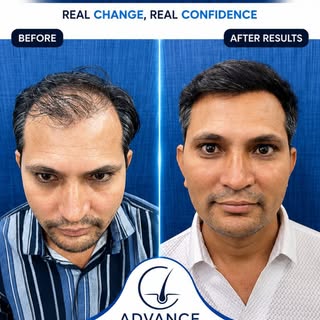Hair transplant results can start becoming visible within just a few months with proper care and exp