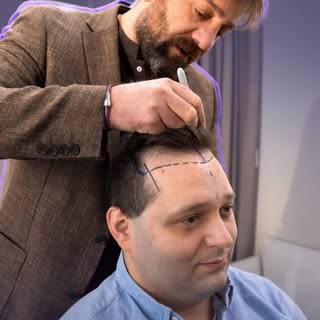 “After the local anesthesia, I didn’t experience any pain.” 💬

Directly after his hair transplant, 