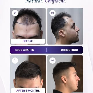 Six months ago, Barış began his hair restoration journey in Istanbul.

Today, he shares his 6-month 