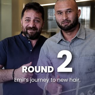 Emil came back for the second part of his hair restoration journey.

Due to the extent of his hair l